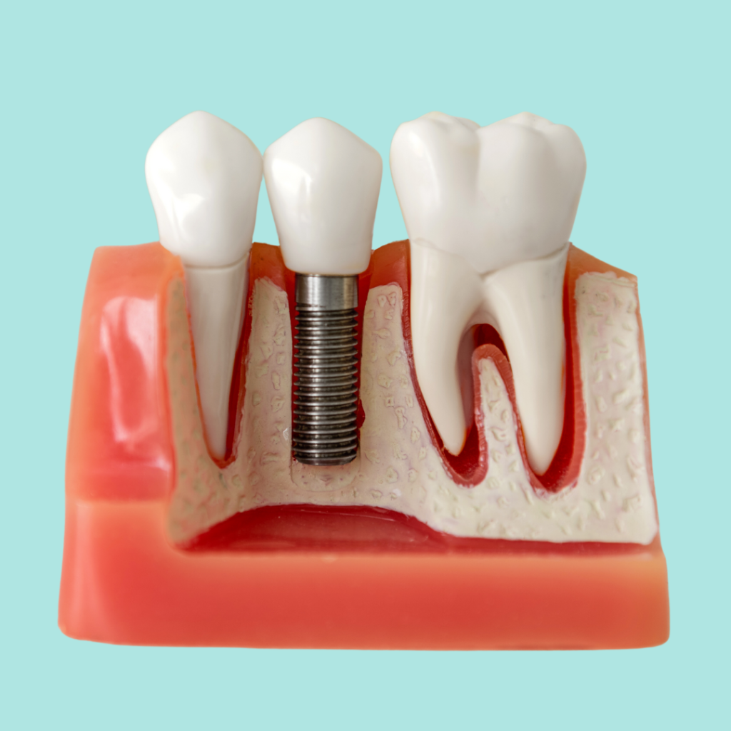 Dental Implants Family Dentist in Penrith